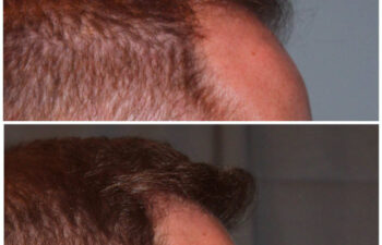 34 year old male 7 months post 2000 graft frontal hairline hair transplant. About 60% regrowth of what he will have at 18 months.