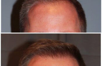 34 year old male 7 months post 2000 graft frontal hairline hair transplant. About 60% regrowth of what he will have at 18 months.