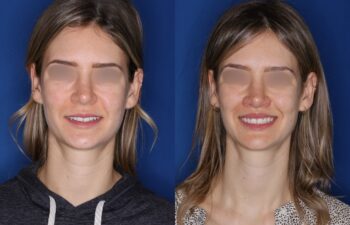 31 year old female 4 months post perialar lip lift