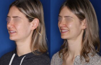 31 year old female 4 months post perialar lip lift