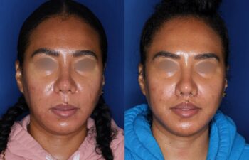 Side-by-side comparison of a woman before and after a cosmetic procedure, showing changes to the appearance of her nose and lips.