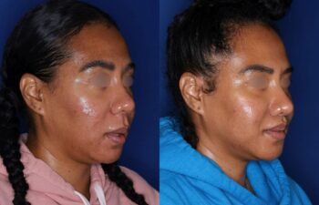 Side-by-side before-and-after photos of a woman with improved skin texture and clarity, wearing different colored hoodies against a blue background.