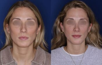 28-year-old female, before and 6 months after rhinoplasty, front view, Kalos Facial Plastic Surgery
