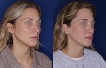 28-year-old female, before and 6 months after rhinoplasty, oblique right view, Kalos Facial Plastic Surgery