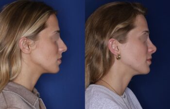 28-year-old female, before and 6 months after rhinoplasty, profile right view, Kalos Facial Plastic Surgery