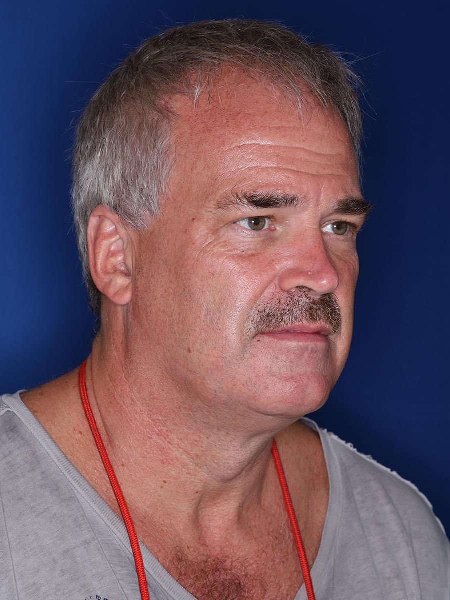 57 year old male 12 months following 3000 grafts to restore frontal/temporal hairline