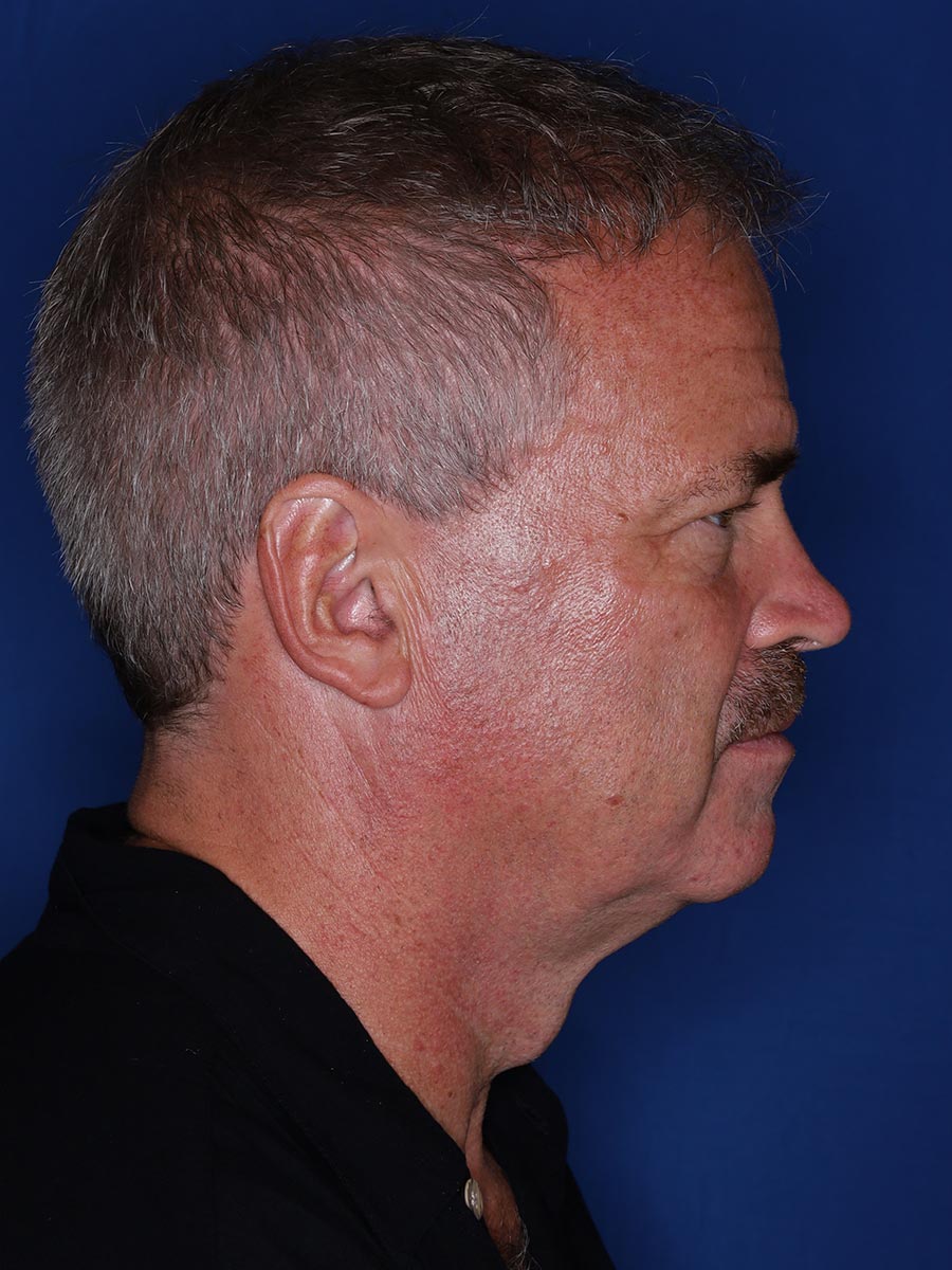57 year old male 12 months following 3000 grafts to restore frontal/temporal hairline