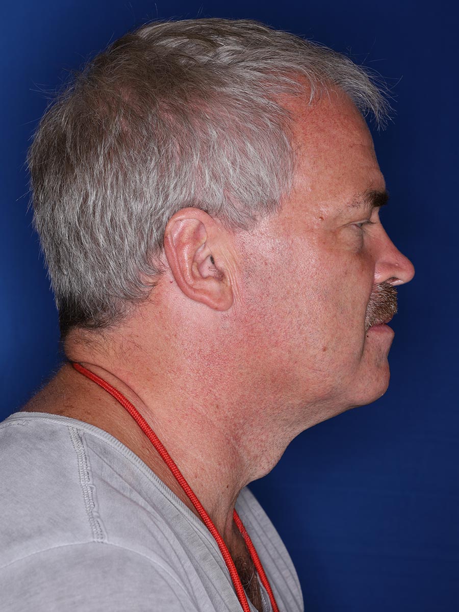 57 year old male 12 months following 3000 grafts to restore frontal/temporal hairline