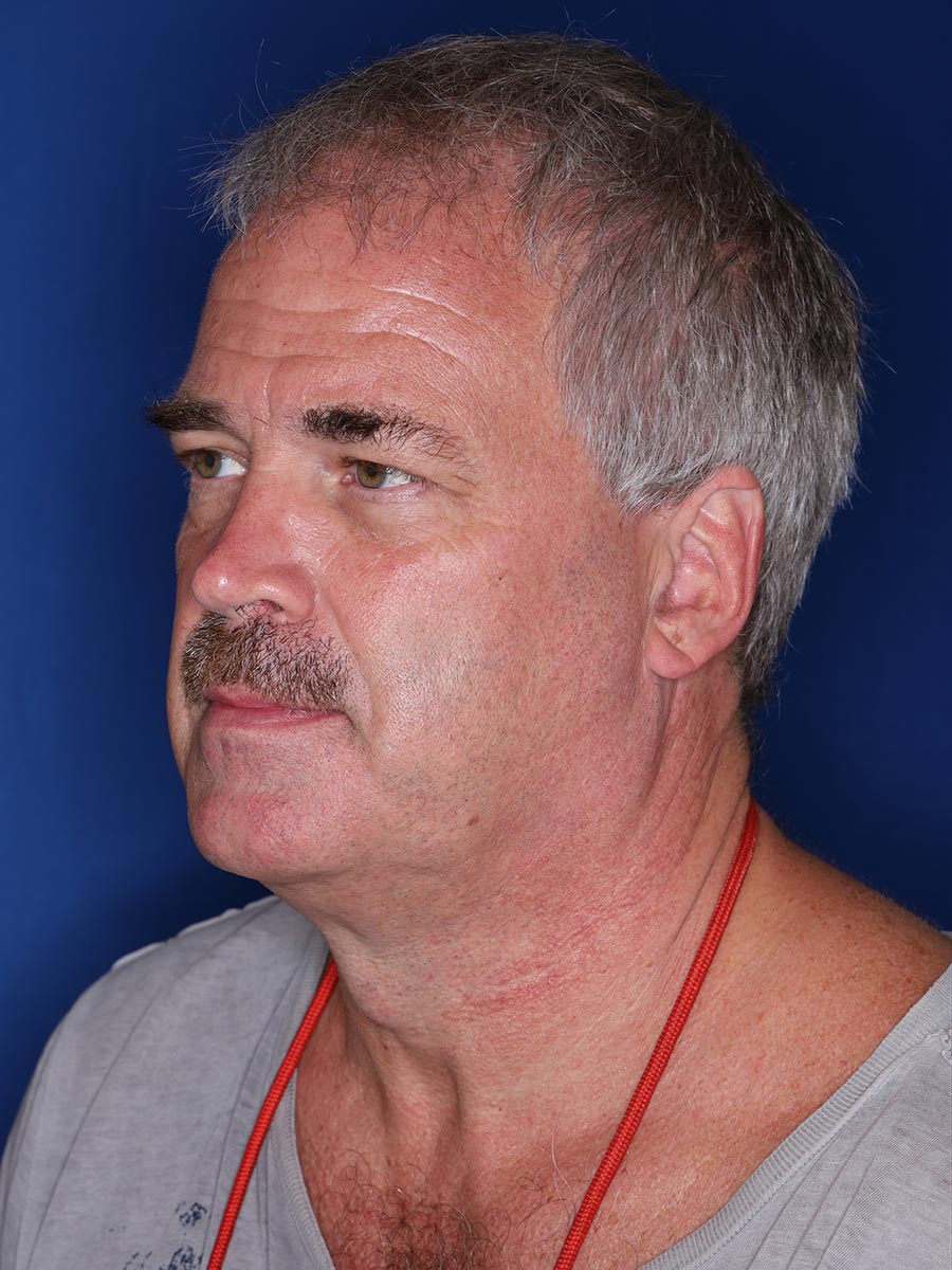 57 year old male 12 months following 3000 grafts to restore frontal/temporal hairline