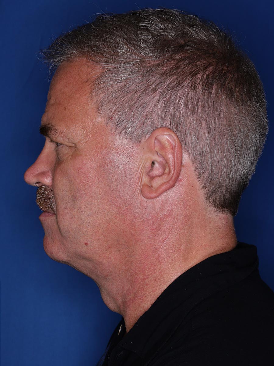 57 year old male 12 months following 3000 grafts to restore frontal/temporal hairline
