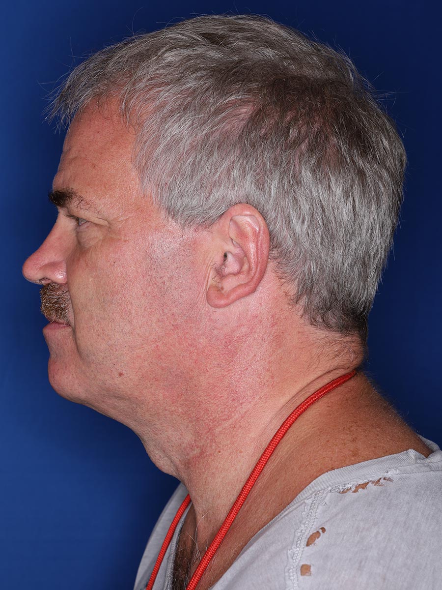 57 year old male 12 months following 3000 grafts to restore frontal/temporal hairline