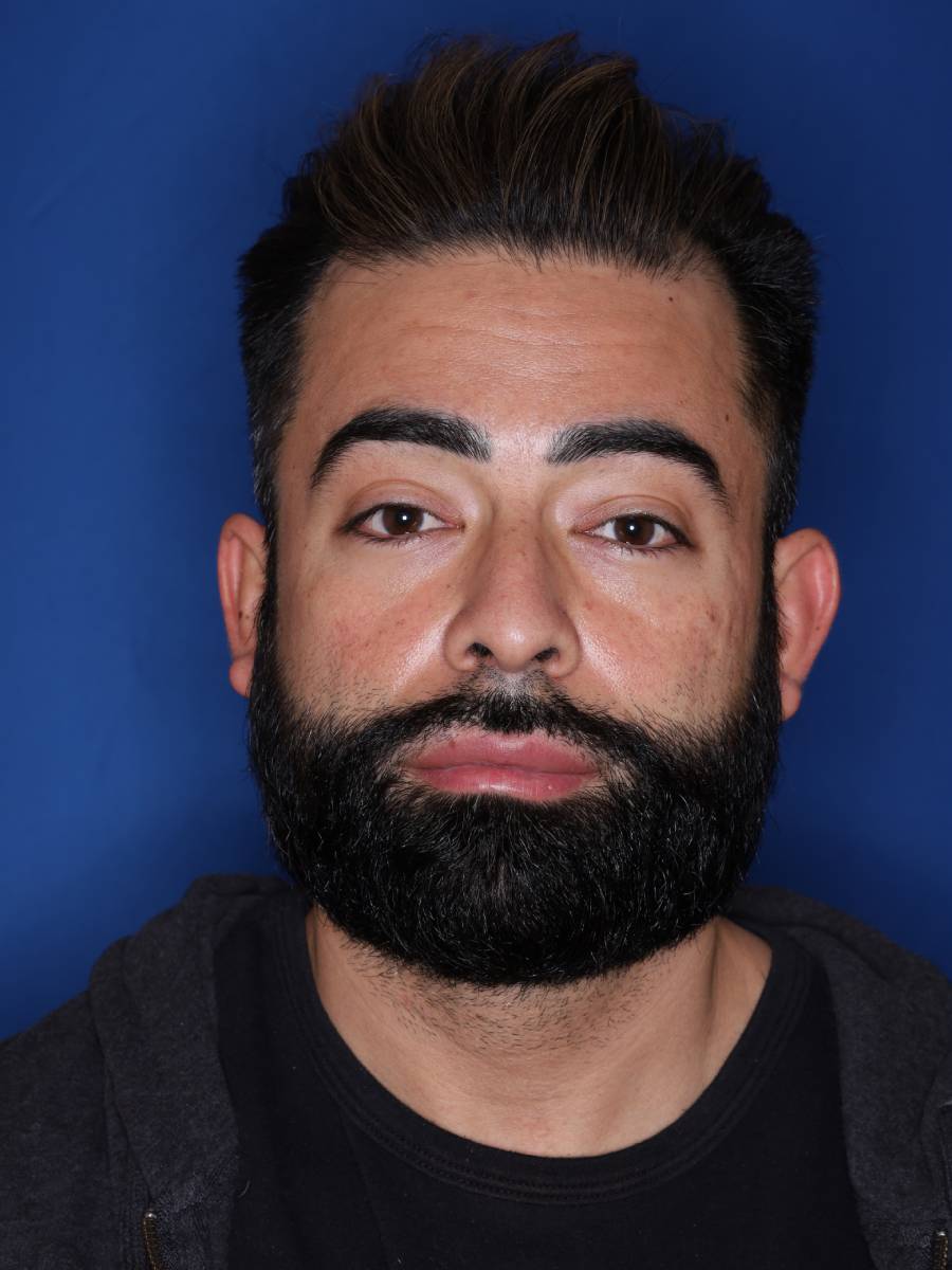 39 year old male one year following 1500 grafts to frontal temporal hair line