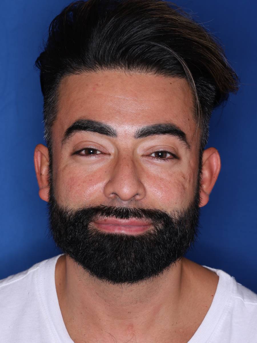 39 year old male one year following 1500 grafts to frontal temporal hair line