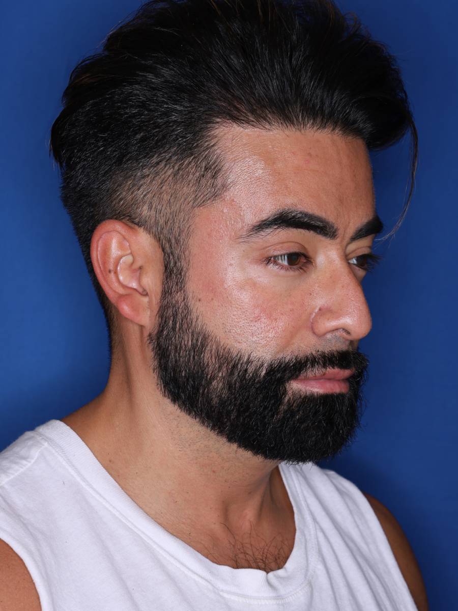 39 year old male one year following 1500 grafts to frontal temporal hair line
