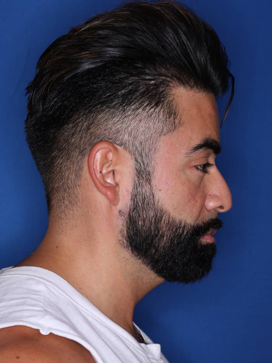 39 year old male one year following 1500 grafts to frontal temporal hair line