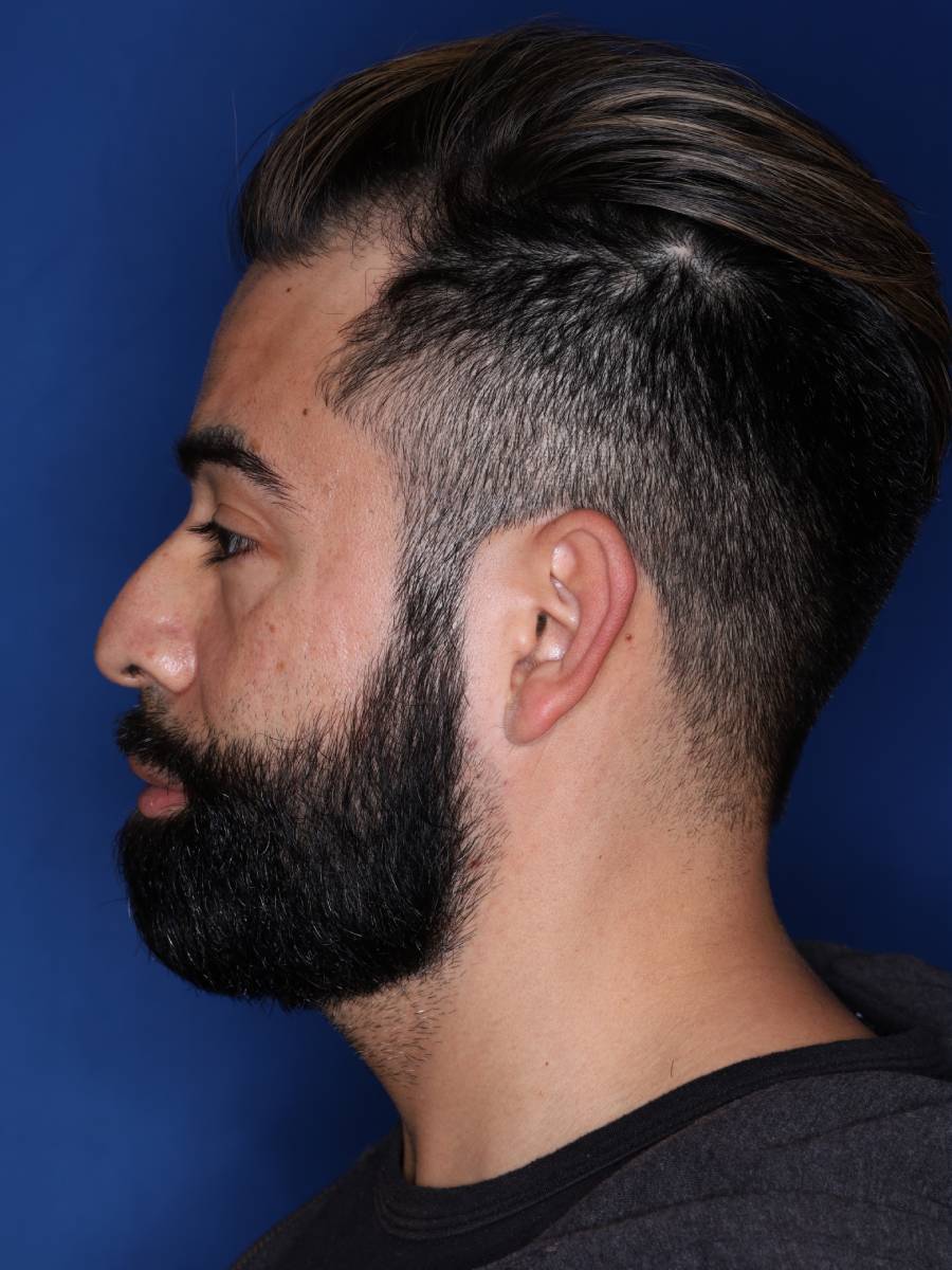 39 year old male one year following 1500 grafts to frontal temporal hair line
