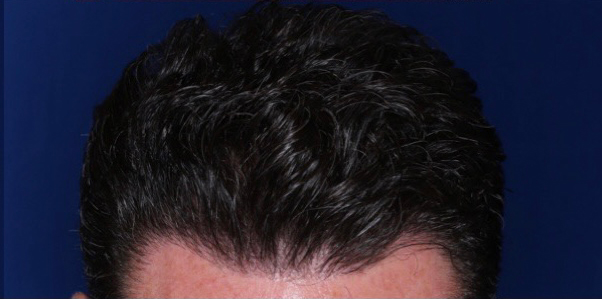 52 year old male 8 months following 2000 grafts to restore frontal temporal hair loss