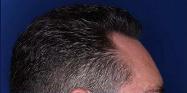 52 year old male 8 months following 2000 grafts to restore frontal temporal hair loss