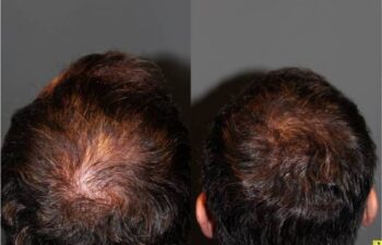 36 year old male 9 months postop from Neograft FUE crown hair transplant restoration with 1200 grafts