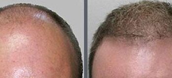 Before and after one hair transplant using the follicular unit extraction method of hair transplantation with NeoGraft, one session of 2500 hair grafts.