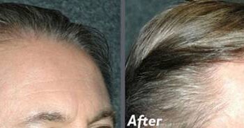 Before and after hair transplant session of 2000 grafts by follicular unit grafting using the thin strip method.