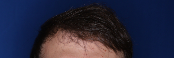 37-year-old male before 3,000 graft hair transplant