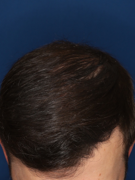 37-year-old male, 15 months after 3,000 graft hair transplant