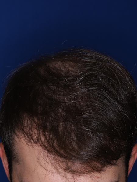 37-year-old male before 3,000 graft hair transplant