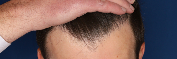 37-year-old male, 15 months after 3,000 graft hair transplant