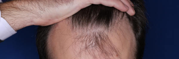 37-year-old male before 3,000 graft hair transplant