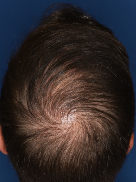 37-year-old male, 15 months after 3,000 graft hair transplant