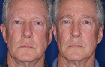 67 year old male 7 months following full eyebrow transplant.