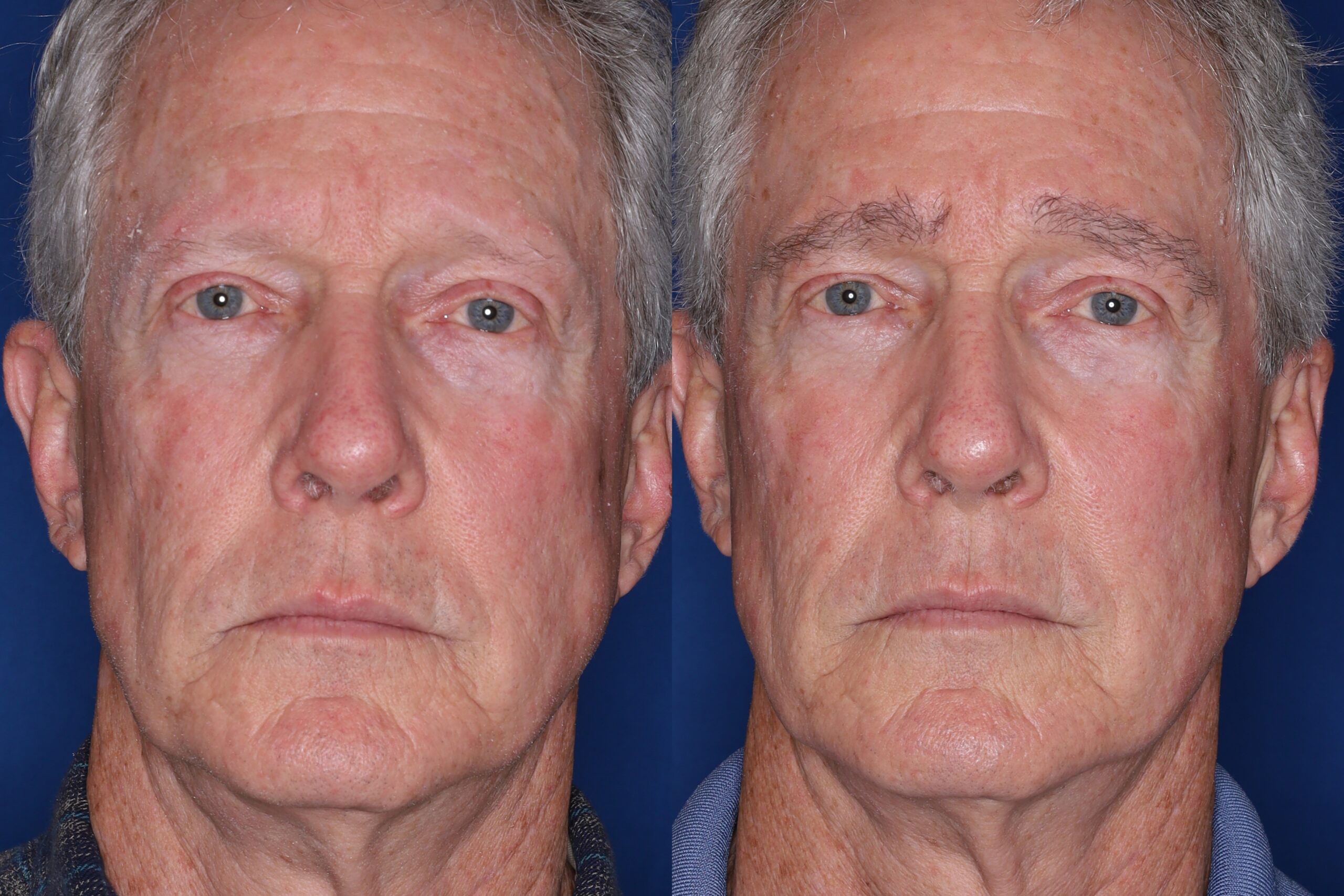 67 year old male 7 months following full eyebrow transplant.
