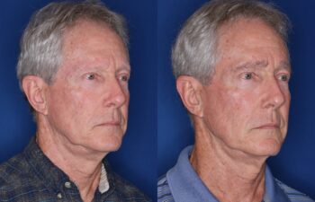 67 year old male 7 months following full eyebrow transplant.
