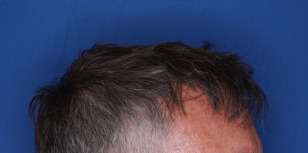 after hair transplant