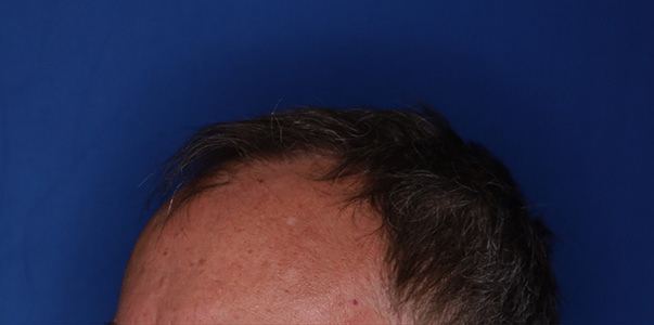 before hair transplant