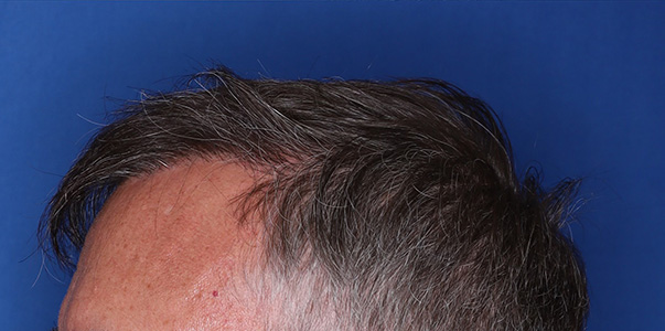 after hair transplant