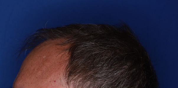 before hair transplant