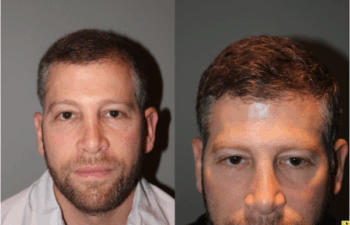 36 yo male 6 months after neograft hair transplant procedure with 1500 grafts