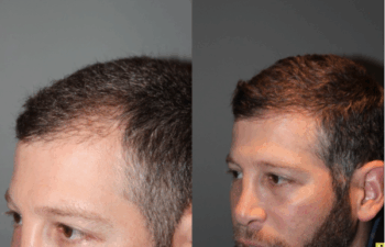 36 yo male 6 months after neograft hair transplant procedure with 1500 grafts