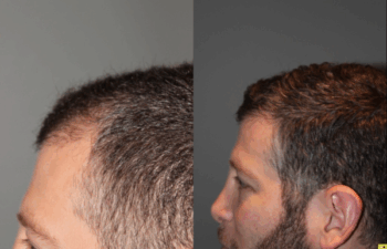 36 yo male 6 months after neograft hair transplant procedure with 1500 grafts