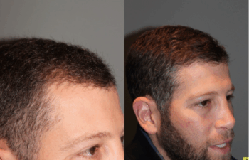 36 yo male 6 months after neograft hair transplant procedure with 1500 grafts