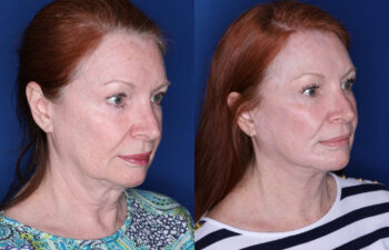 Side-by-side photos showing an older woman before and after a cosmetic procedure, highlighting smoother skin and reduced wrinkles in the "after" image.
