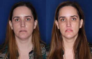 45 year old female 6 months post Perialar Lip Lift