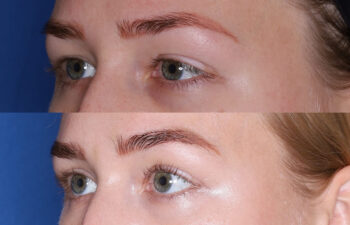 Two close-up photos of a person's face showing the eyebrows before and after enhancement or treatment. The lower image shows fuller and more defined eyebrows.