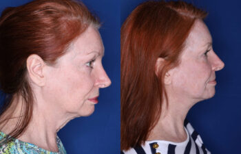 Side-by-side profile photos of a woman before and after a cosmetic procedure, showing reduced sagging and a more defined jawline in the after image.