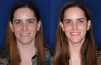 45 year old female 6 months post Perialar Lip Lift