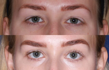 Close-up of a person's eyes and eyebrows before (top) and after (bottom) an eyebrow enhancement treatment, showing fuller and more defined brows in the after image.