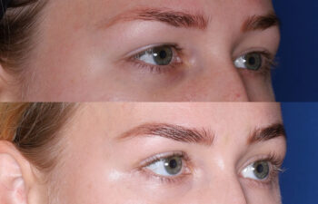 Two close-up images show a person's eyes and eyebrows before (top) and after (bottom) eyebrow grooming or cosmetic enhancement.