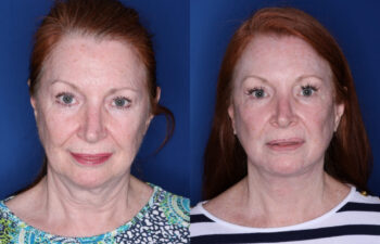 Two side-by-side photos of the same older woman with fair skin and red hair, facing forward; the left photo shows her before and the right photo shows her after a cosmetic procedure.